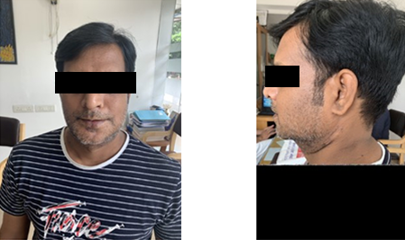 Jaw Bone Cancer